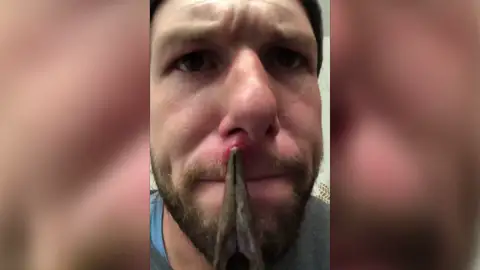 Christopher Yocom sacándose el grano Christopher Yocom sacándose el grano