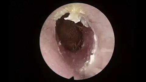 Cucaracha dentro de la oreja Cucaracha dentro de la oreja