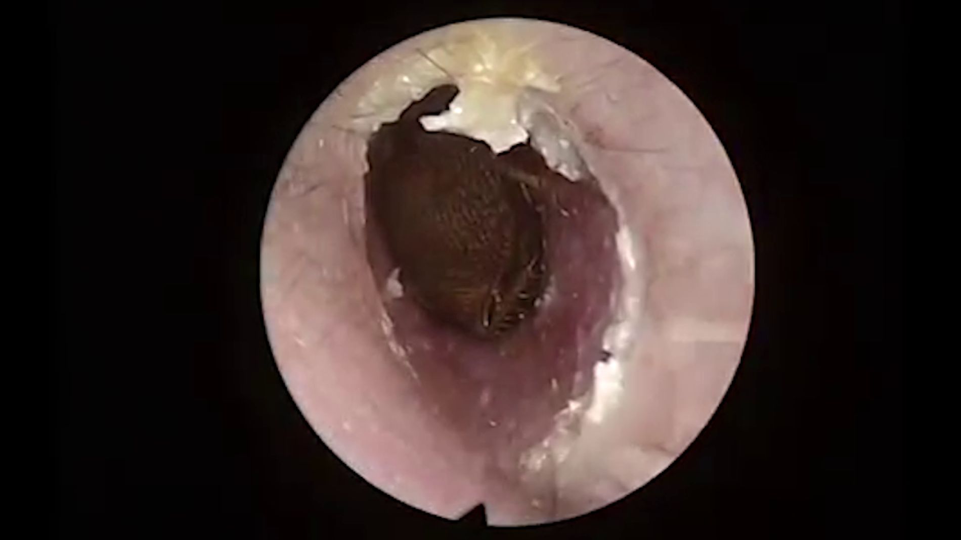 Cucaracha dentro de la oreja