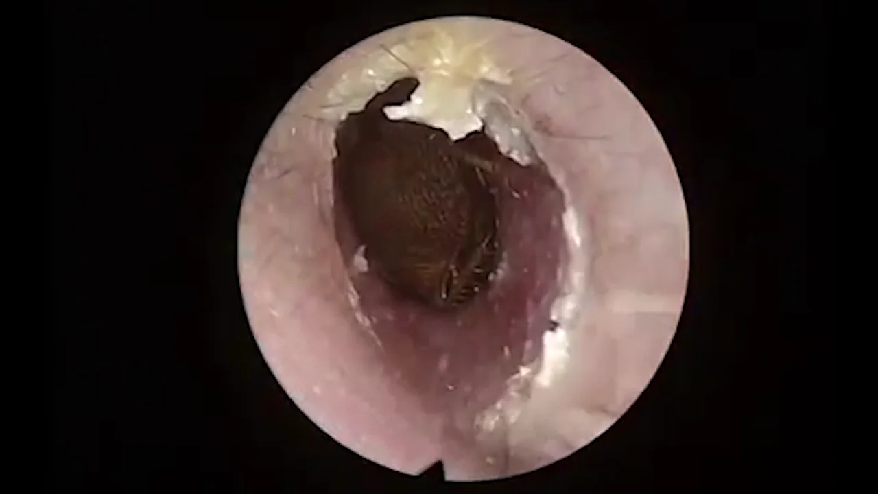 Cucaracha dentro de la oreja