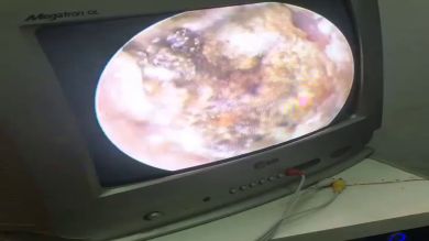 VÍDEO: Un doctor elimina 15 años de cera de la orejas de una paciente