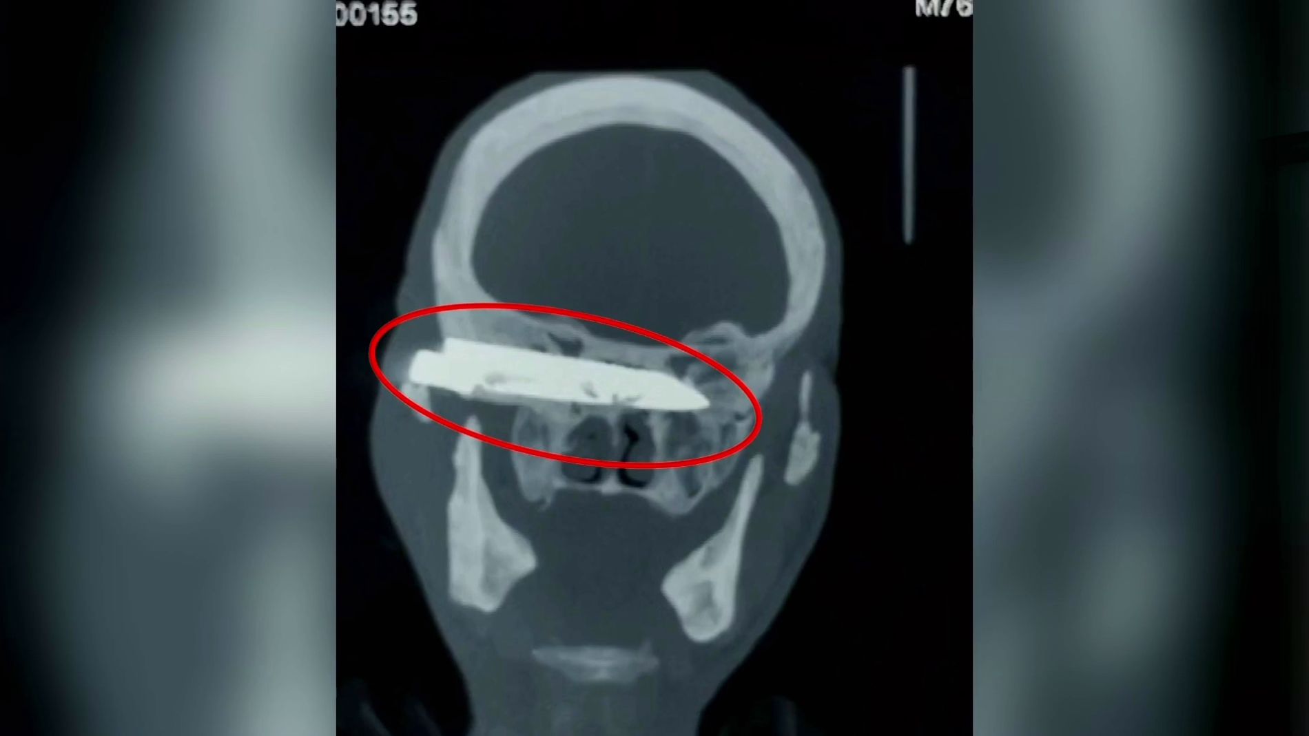 Pu&ntilde;al alojado en el cerebro