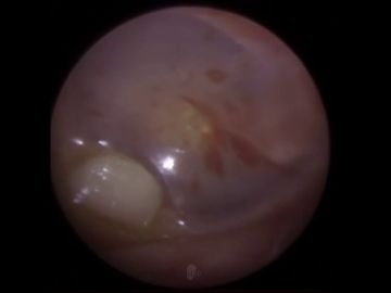 VÍDEO: Un doctor extrae un diente de la oreja de un niño