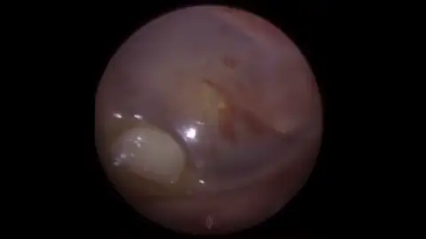 VÍDEO: Un doctor extrae un diente de la oreja de un niño VÍDEO: Un doctor extrae un diente de la oreja de un niño