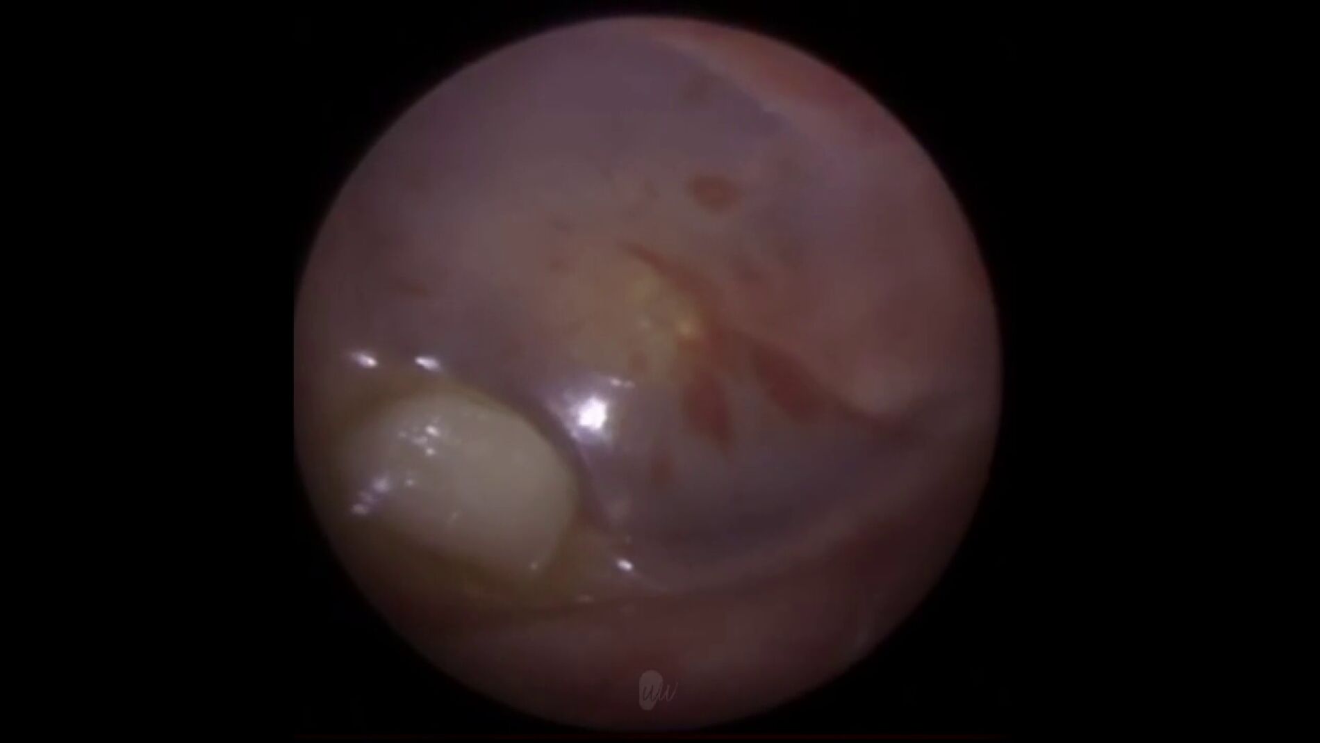 V&Iacute;DEO: Un doctor extrae un diente de la oreja de un ni&ntilde;o
