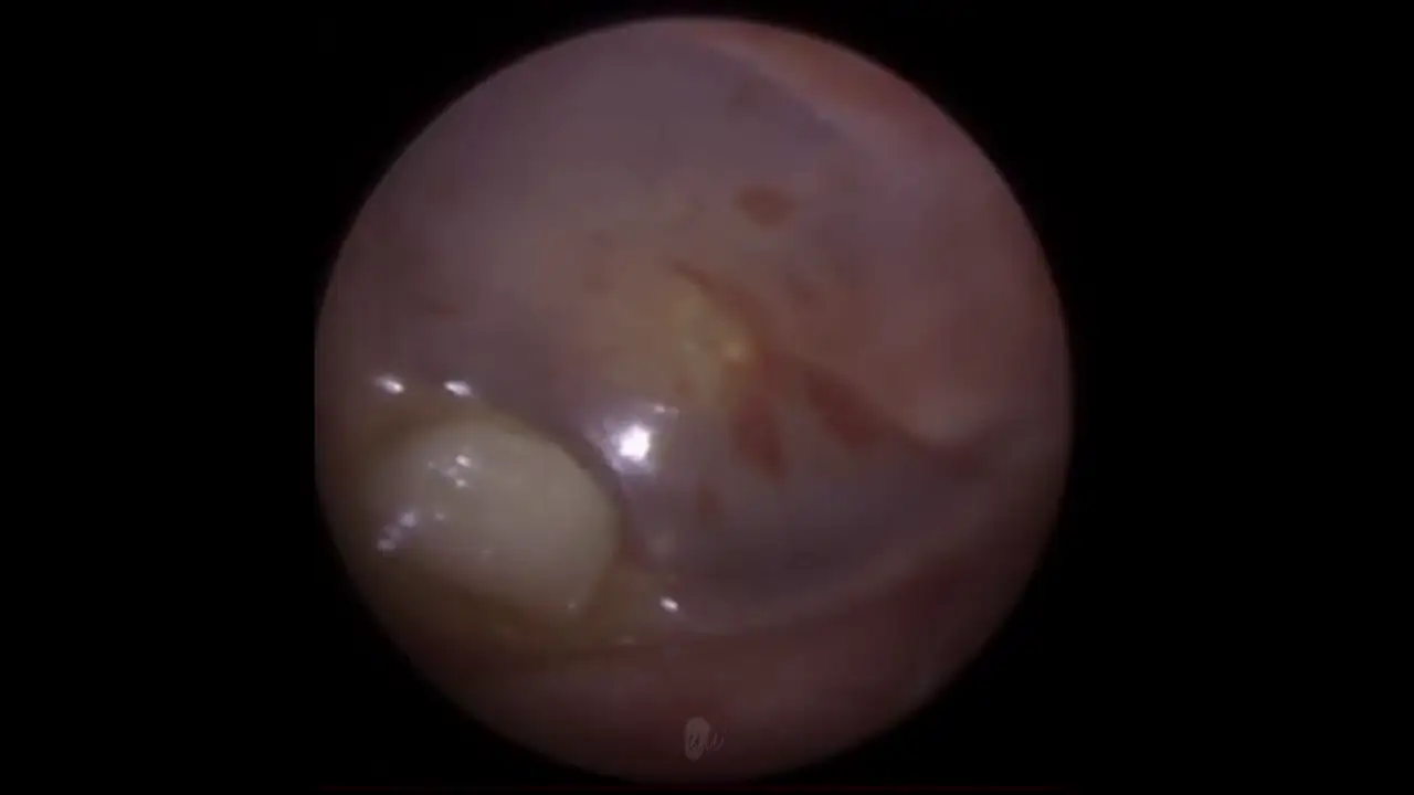 VÍDEO: Un doctor extrae un diente de la oreja de un niño
