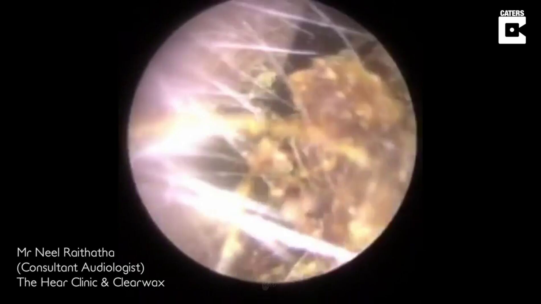 Un audi&oacute;logo elimina la mayor cantidad de cera para los o&iacute;dos