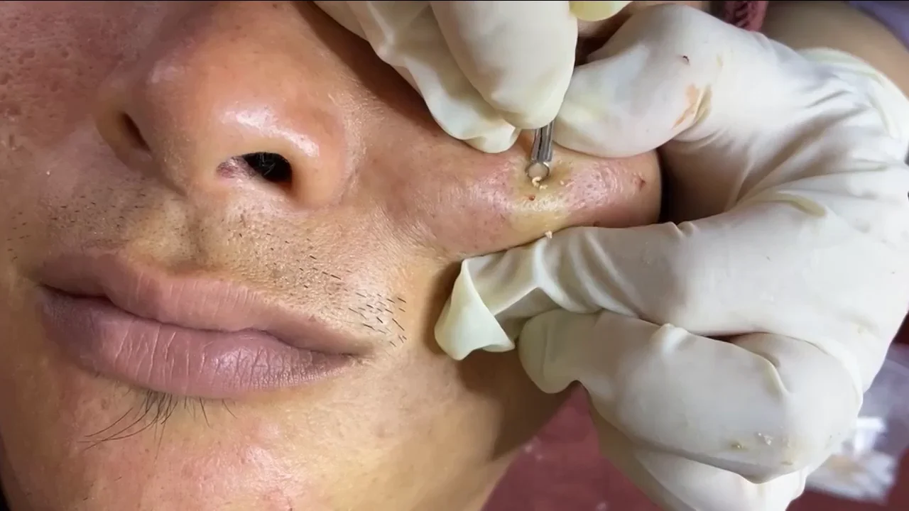 Un dermatólogo quita un gigantesco grano de la mejilla de un paciente