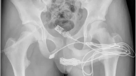 Radiografía que muestra el cable dentro del pene Radiografía que muestra el cable dentro del pene
