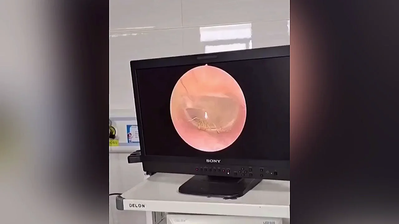 VÍDEO: Médico extrae una araña viva de la oreja de una mujer en China