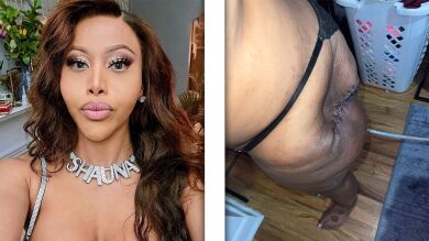 Dejan un agujero en el cuerpo de una mujer transgénero por culpa de unas inyecciones de silicona