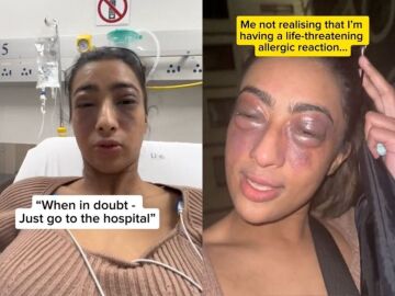 Tiene una reacci&oacute;n al&eacute;rgica que podr&iacute;a haber acabado con su vida y decide grabarlo en TikTok