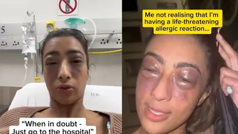 Tiene una reacción alérgica que podría haber acabado con su vida y decide grabarlo en TikTok Tiene una reacción alérgica que podría haber acabado con su vida y decide grabarlo en TikTok