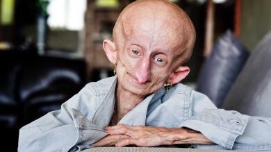 Fallece Beandri Booysen, la influencer de 19 años que inspiró al mundo con su lucha contra la progeria
