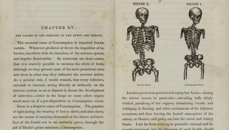 Popular pathology: Pancoast on the curability of consumption: medicated inhalation. 1855.