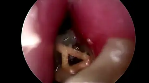 Letra atascada en la nariz de un bebé Letra atascada en la nariz de un bebé