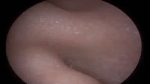 Encuentran extraño objeto dentro de su oreja Encuentran extraño objeto dentro de su oreja