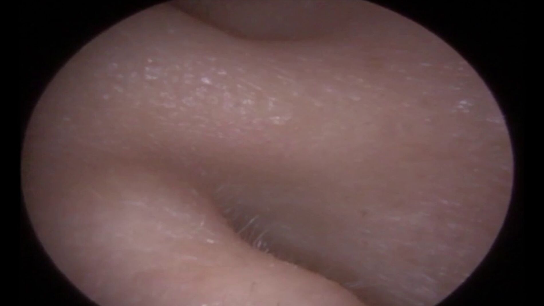 Encuentran extra&ntilde;o objeto dentro de su oreja