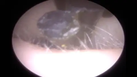 Sacan objeto de la oreja de un paciente Sacan objeto de la oreja de un paciente