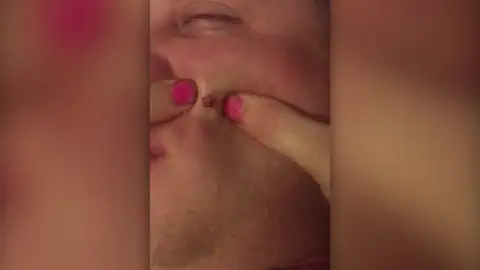 Mujer explota grano Mujer explota grano