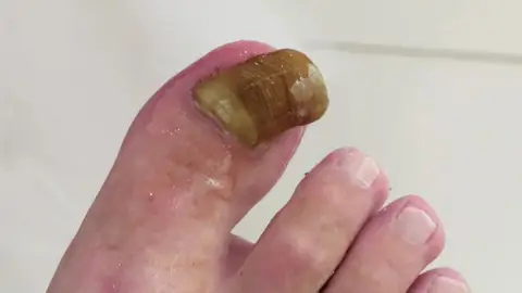 Uña con onicogrifosis Uña con onicogrifosis