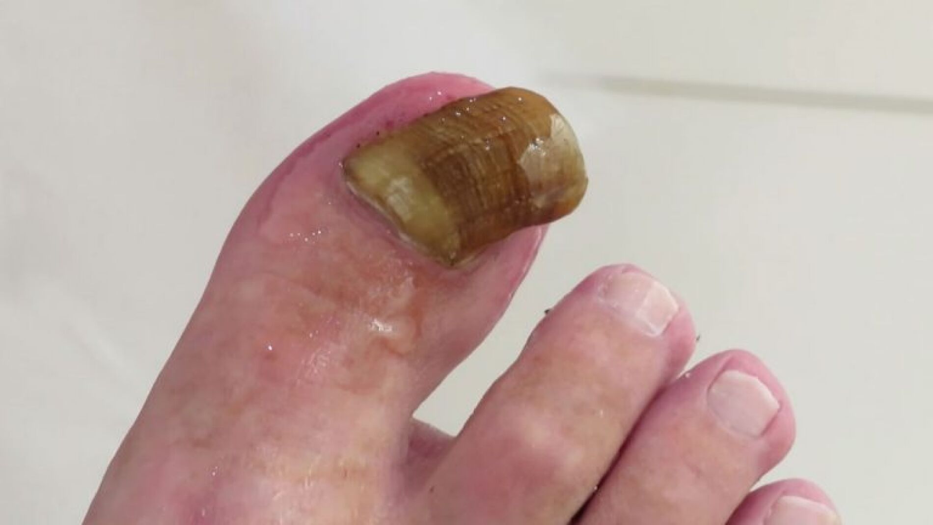 U&ntilde;a con onicogrifosis