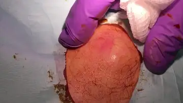 Cirugía en un grano