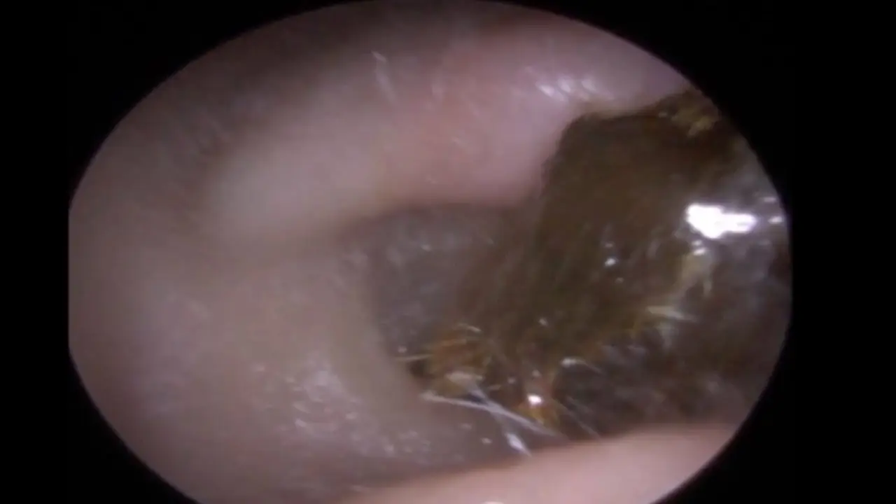 VÍDEO: El satisfactorio momento en que a un hombre le sacan del oído el  tapón de cera más grande que has visto nunca
