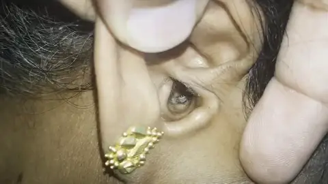 Encuentran una araña dentro de una oreja Encuentran una araña dentro de una oreja