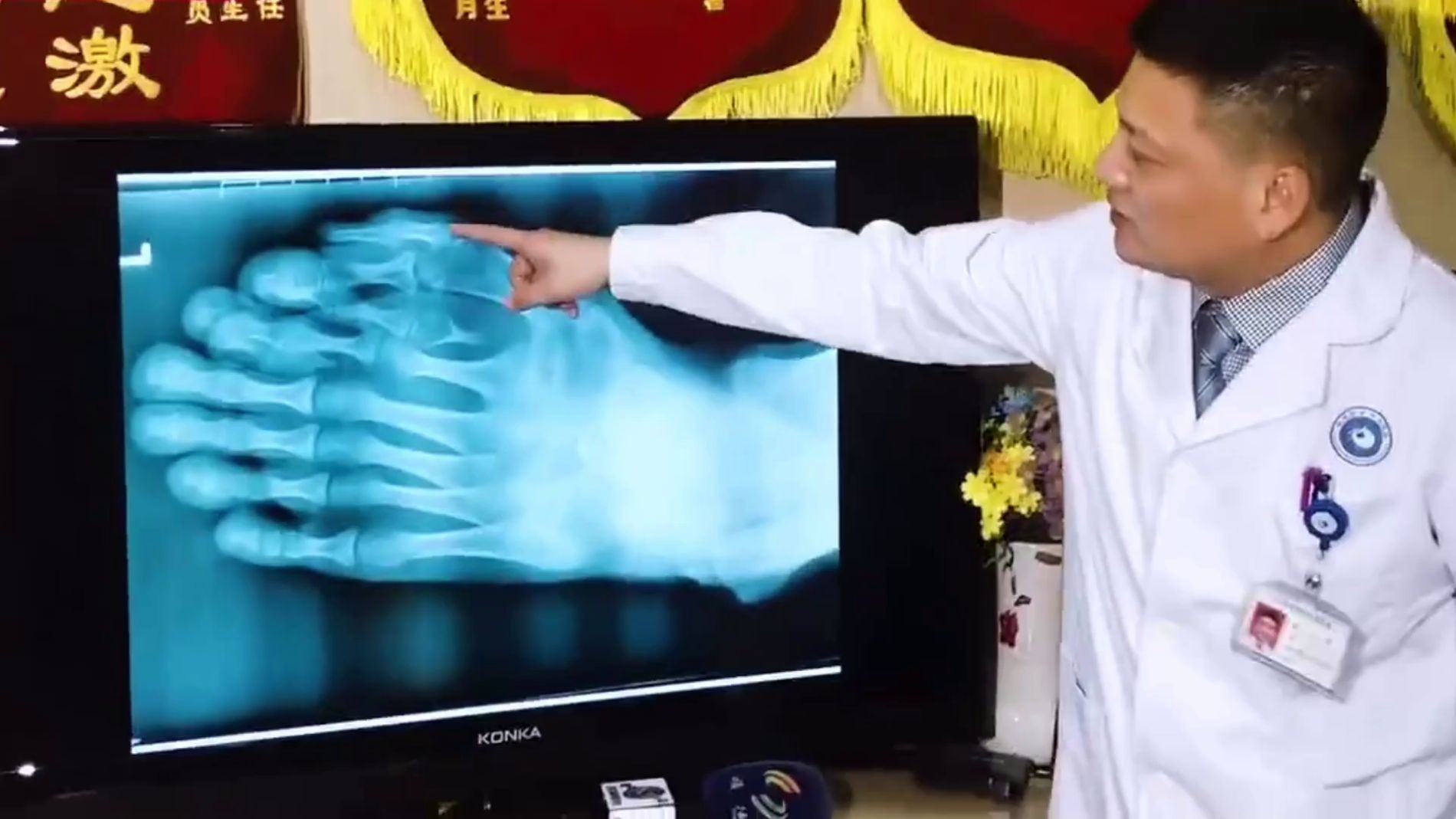 Hombre con nueve dedos en cada pie