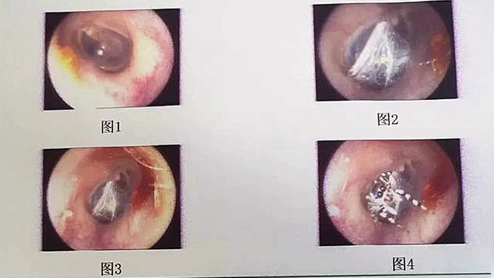 Ara&ntilde;a escondida en una oreja
