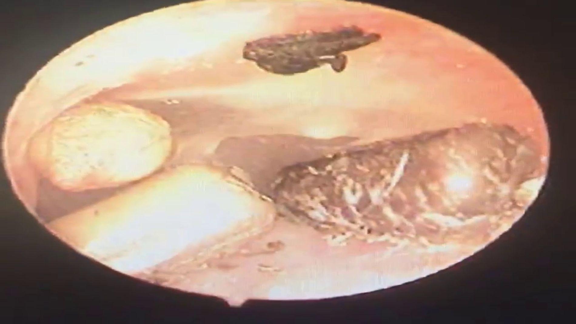 Doctor saca tres judias de un o&iacute;do