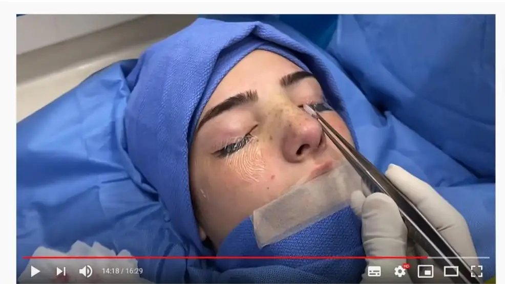 Charli D'Amelio durante su operación de nariz