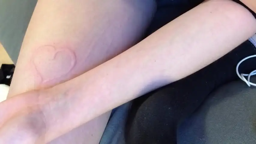 Una adolescente tiene una rara enfermedad que convierte su piel en un telesketch