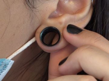 Dilatación en una oreja