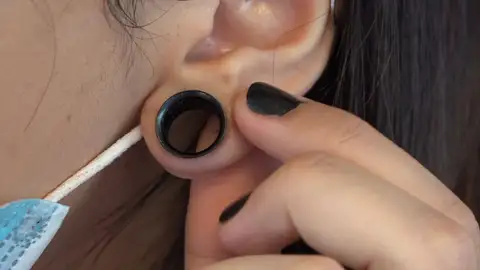 Dilatación en una oreja Dilatación en una oreja