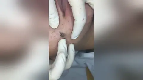 VÍDEO: Un dermatólogo revienta un punto negro gigante en la cara de un paciente VÍDEO: Un dermatólogo revienta un punto negro gigante en la cara de un paciente