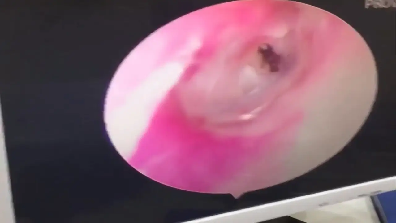 Un médico vietnamita extrae una hormiga venenosa del oído de un paciente