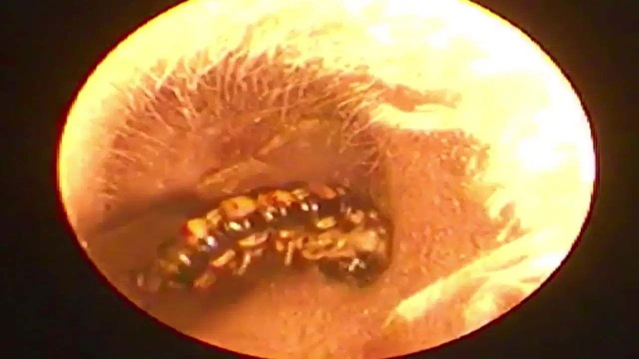 Un médico vietnamita extrae un gusano que llevaba una semana anidando en la oreja de un hombre
