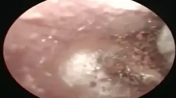 El increíble momento en que un médico vietnamita quita un seta de la oreja de un paciente