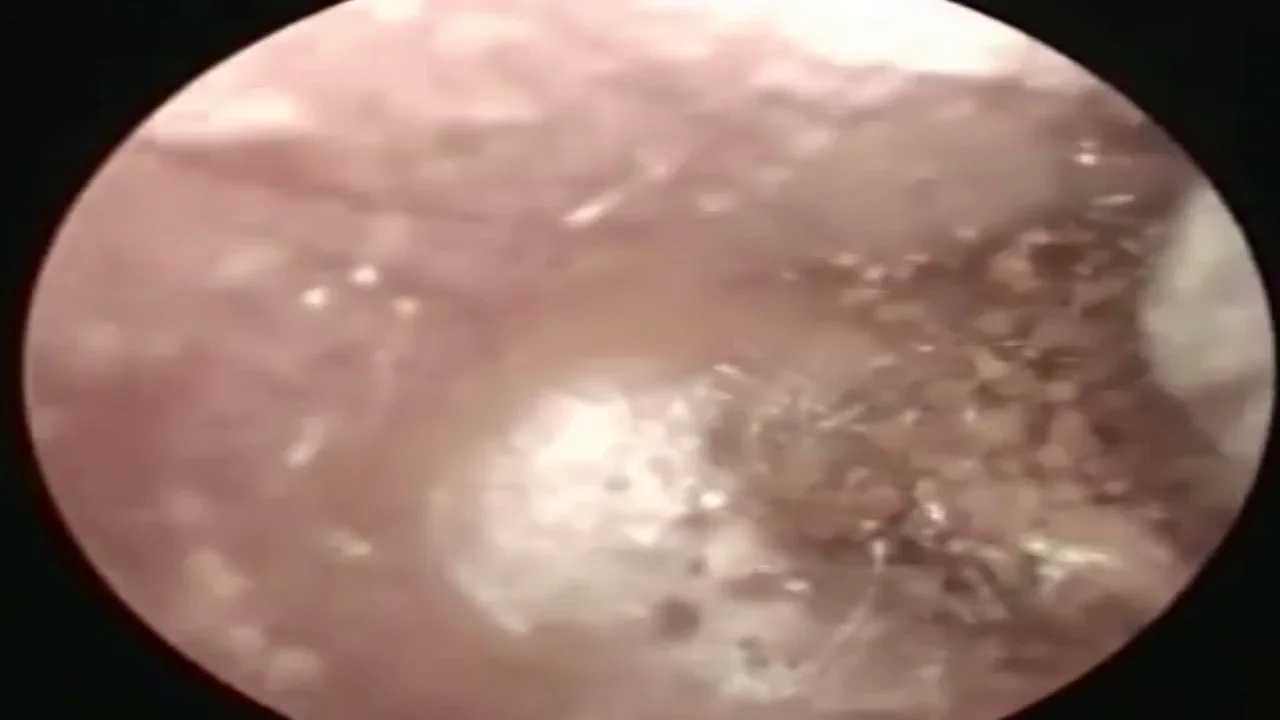 El increíble momento en que un médico vietnamita quita un seta de la oreja de un paciente El increíble momento en que un médico vietnamita quita un seta de la oreja de un paciente