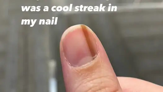 Una tiktoker descubre que la raya en su uña es un cáncer, y su vídeo se hace viral.
