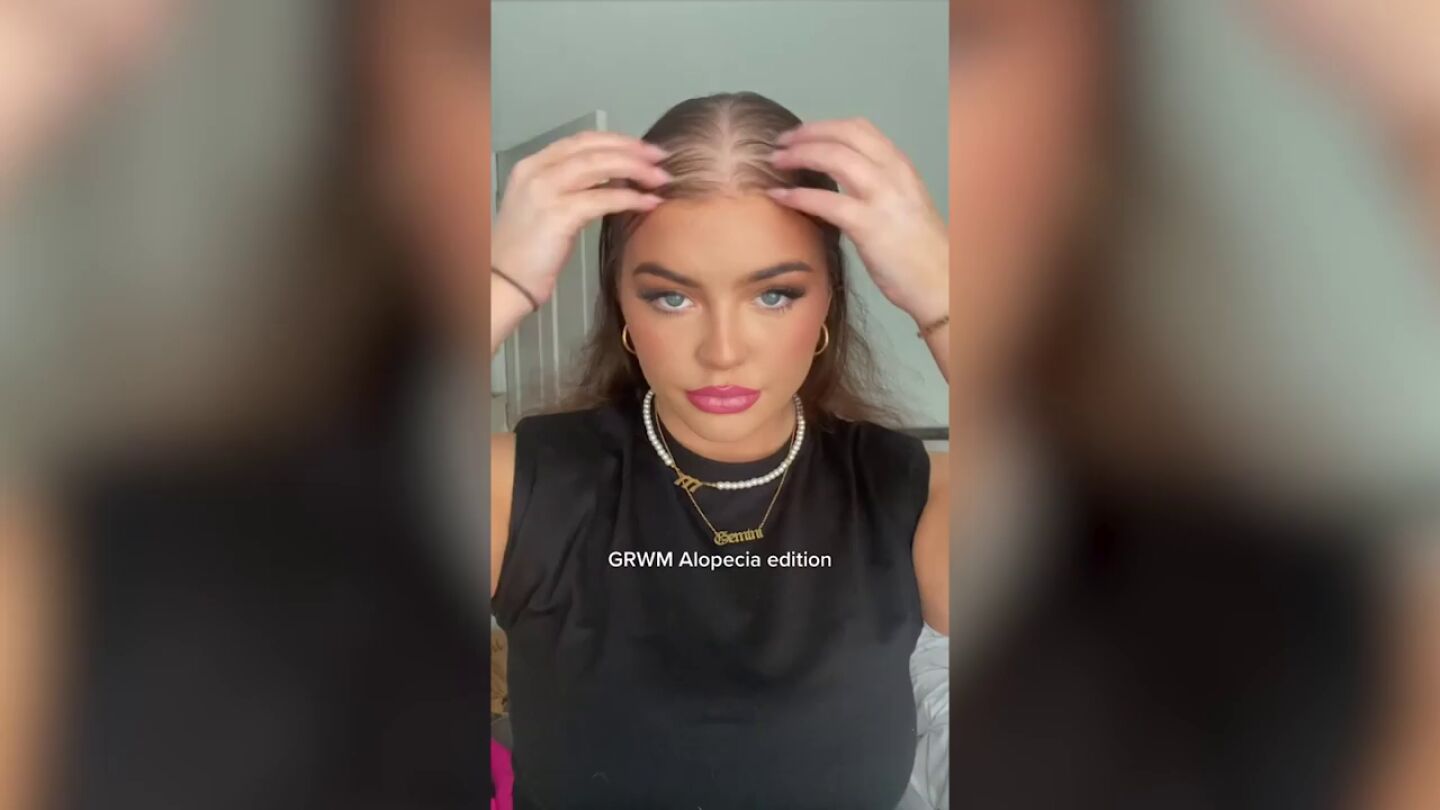 Una mujer pierde el pelo a los 17 a&ntilde;os pero se vuelve viral concienciando sobre la alopecia 
