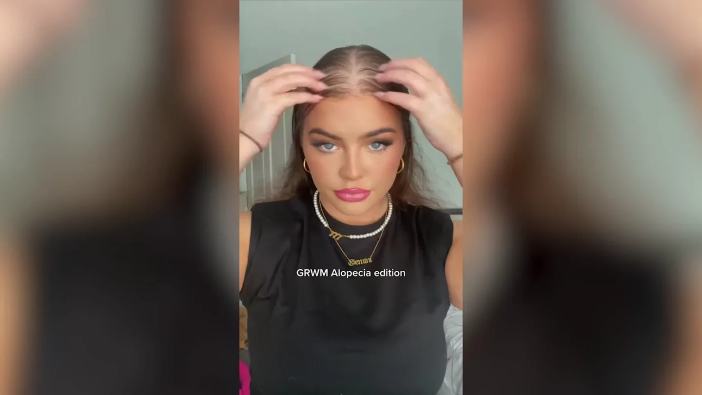 Una mujer pierde el pelo a los 17 años pero se vuelve viral concienciando sobre la alopecia Una mujer pierde el pelo a los 17 años pero se vuelve viral concienciando sobre la alopecia