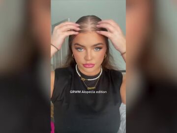 Una mujer pierde el pelo a los 17 años pero se vuelve viral concienciando sobre la alopecia 