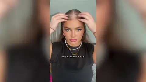 Una mujer pierde el pelo a los 17 años pero se vuelve viral concienciando sobre la alopecia Una mujer pierde el pelo a los 17 años pero se vuelve viral concienciando sobre la alopecia