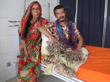 El famoso "hombre árbol" de Bangladesh vuelve a estar hospitalizado