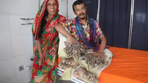 El famoso "hombre árbol" de Bangladesh vuelve a estar hospitalizado El famoso "hombre árbol" de Bangladesh vuelve a estar hospitalizado