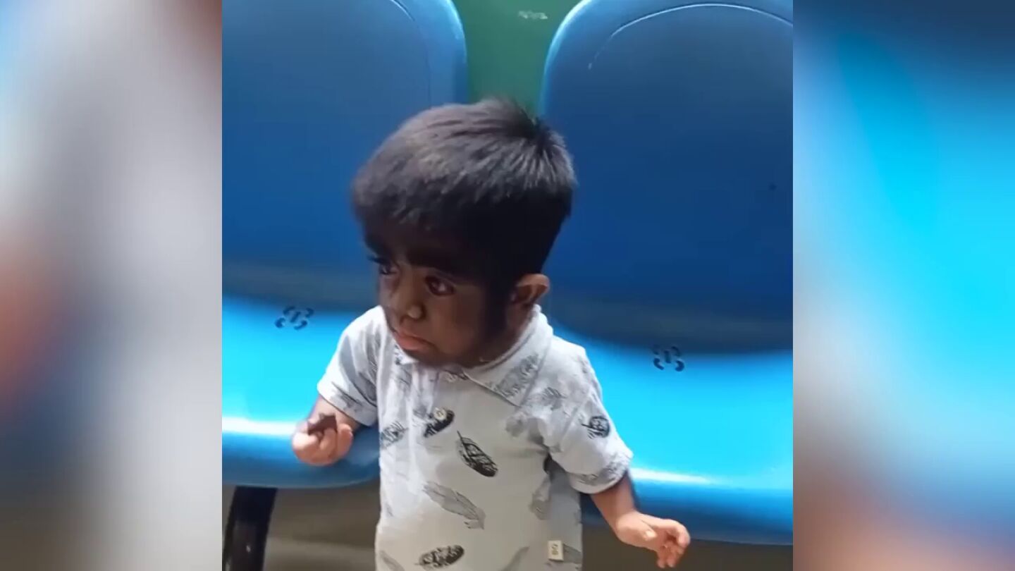 Un ni&ntilde;o de dos a&ntilde;os tiene el s&iacute;ndrome de hombre lobo despu&eacute;s de que su madre "comiera un gato salvaje durante el embarazo"