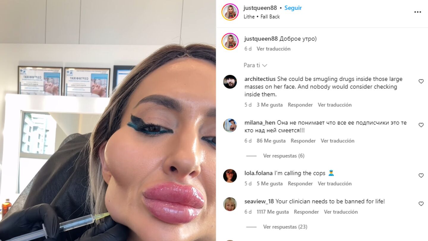 La influencer ucraniana con "las mejillas m&aacute;s grandes del mundo"